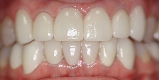 An after picture of teeth that are in line and whitened