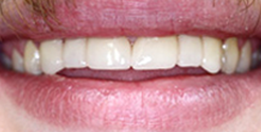 An after picture of teeth that are in line and whitened