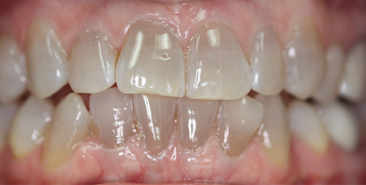 A before photo of misaligned teeth with discoloration