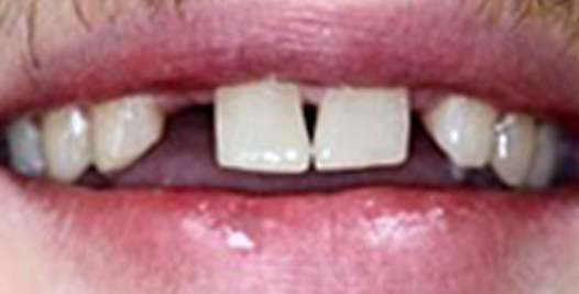 A before photo of misaligned teeth with discoloration